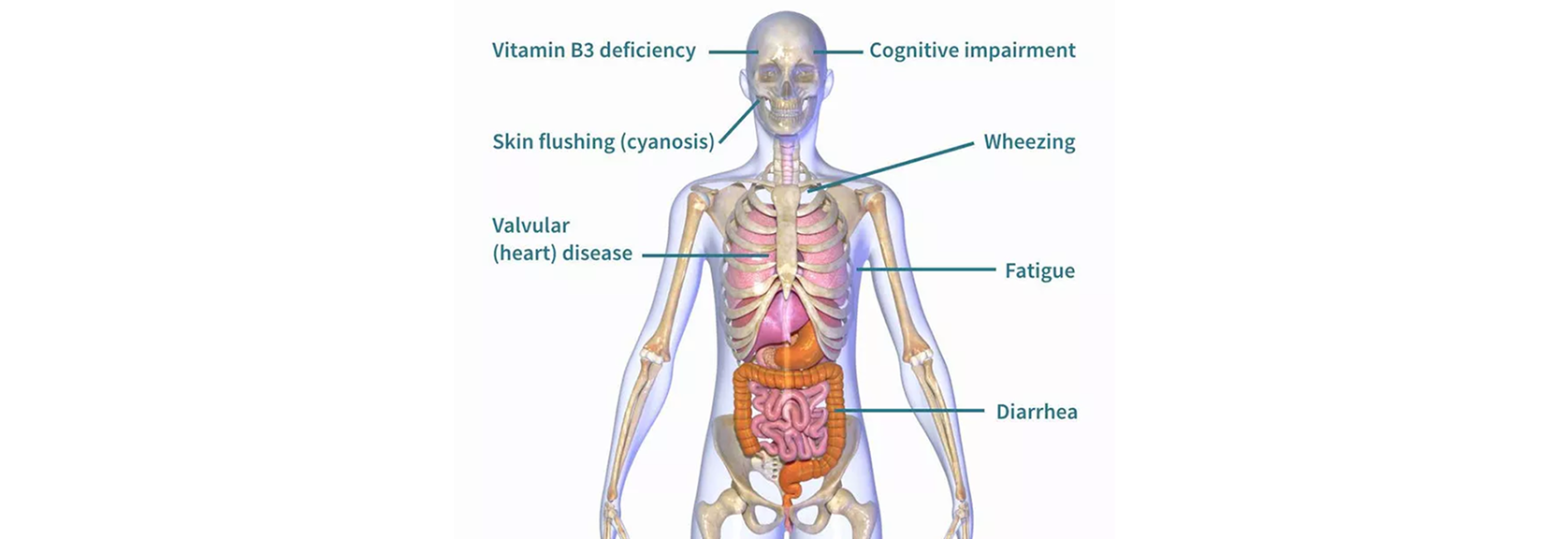 Carcinoid