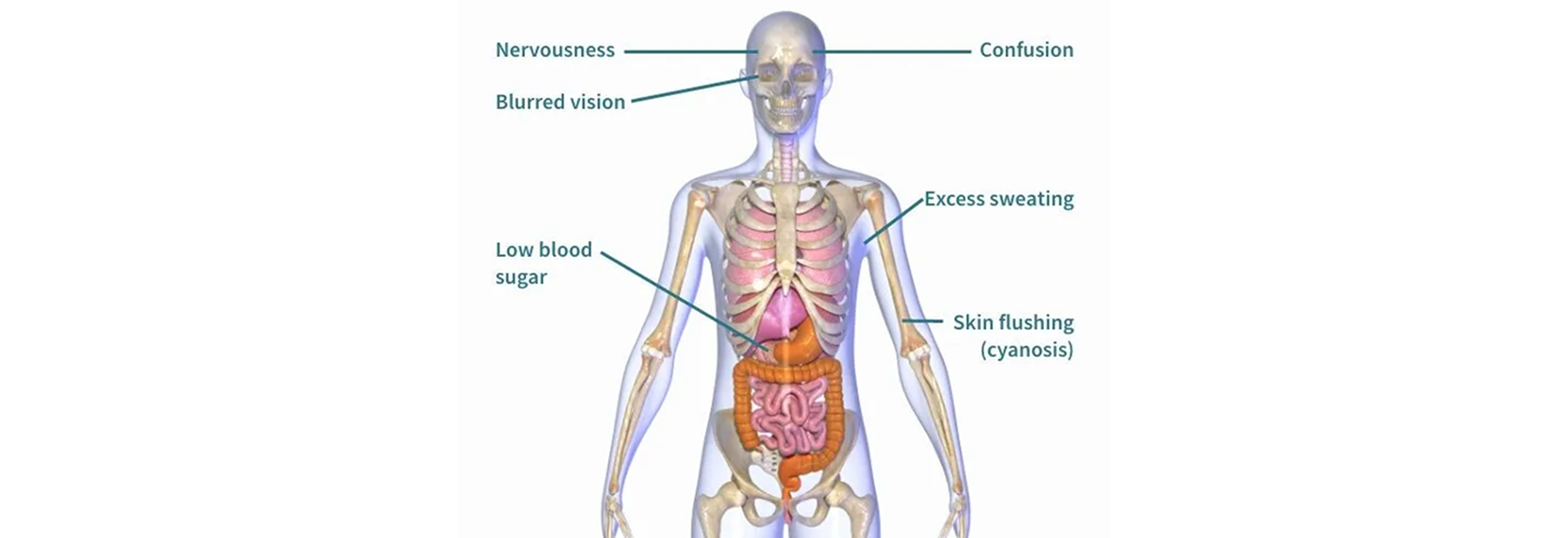 Insulinoma