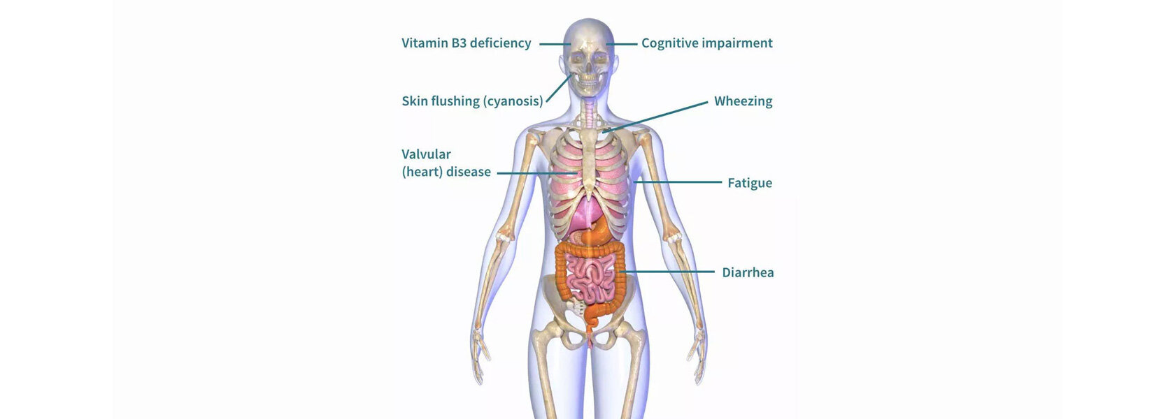 Carcinoid
