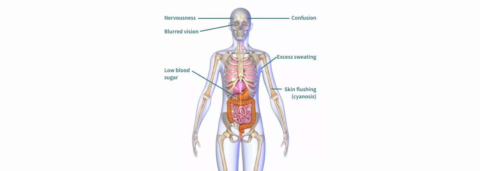 Insulinoma
