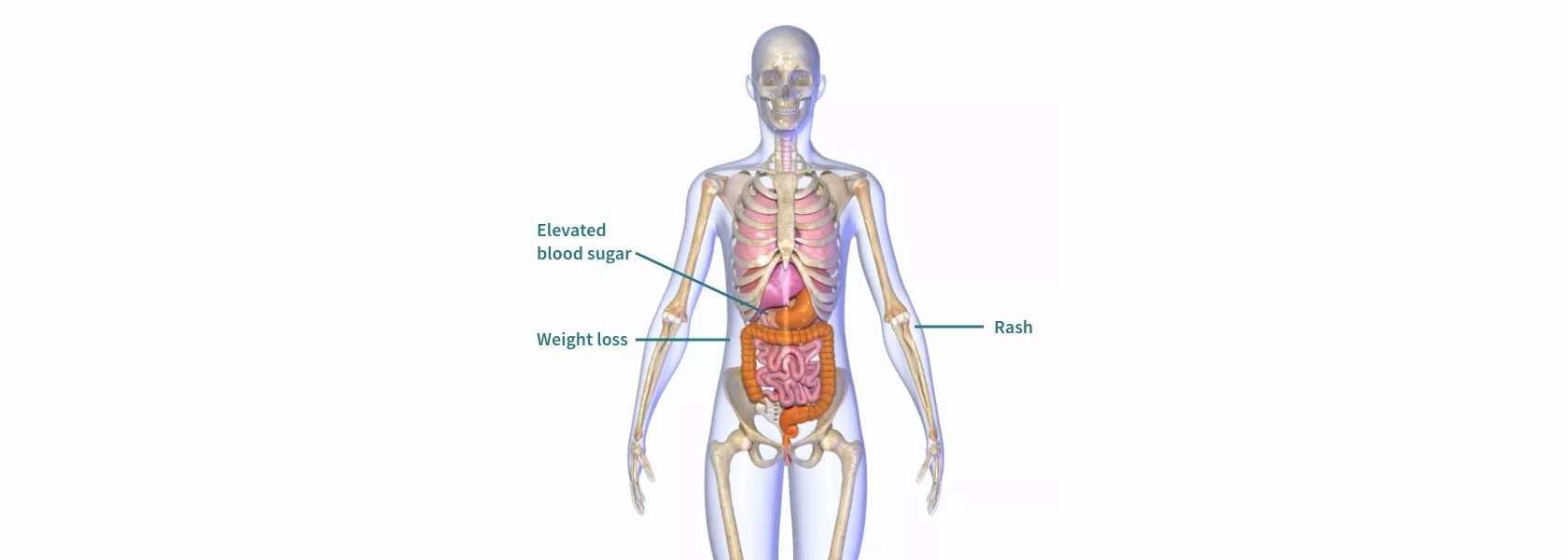 Glucagonoma
